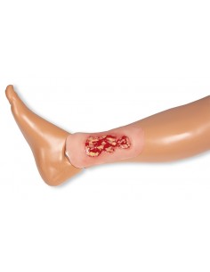 Moulage de úlcera venosa... 2