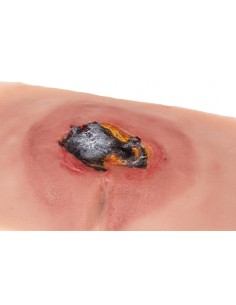 Moulage de úlcera por... 2