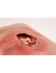 Moulage de úlcera de... 2