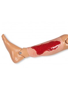 Moulage de una úlcera... 2