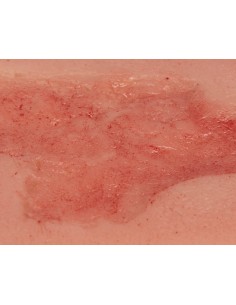 Moulage de herida ulcerosa... 2