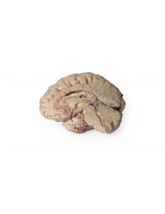 Hemisección cerebral -... 2