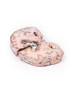 Glioma de grado 3-4, que ha... 2
