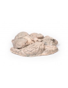 Meningioma - Erler Zimmer...