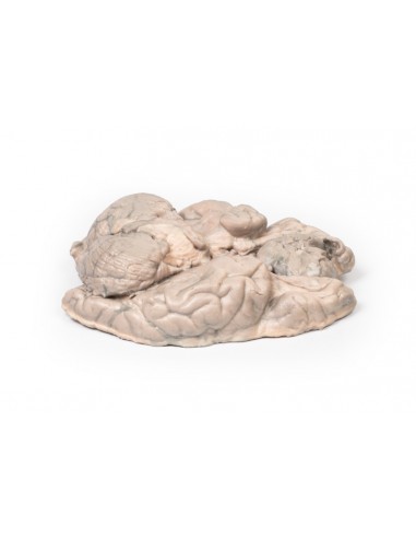 Meningioma - Erler Zimmer 3D anatomy... Meningioma - Erler Zimmer 3D anatomy...