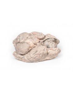 Meningioma - Erler Zimmer... 2
