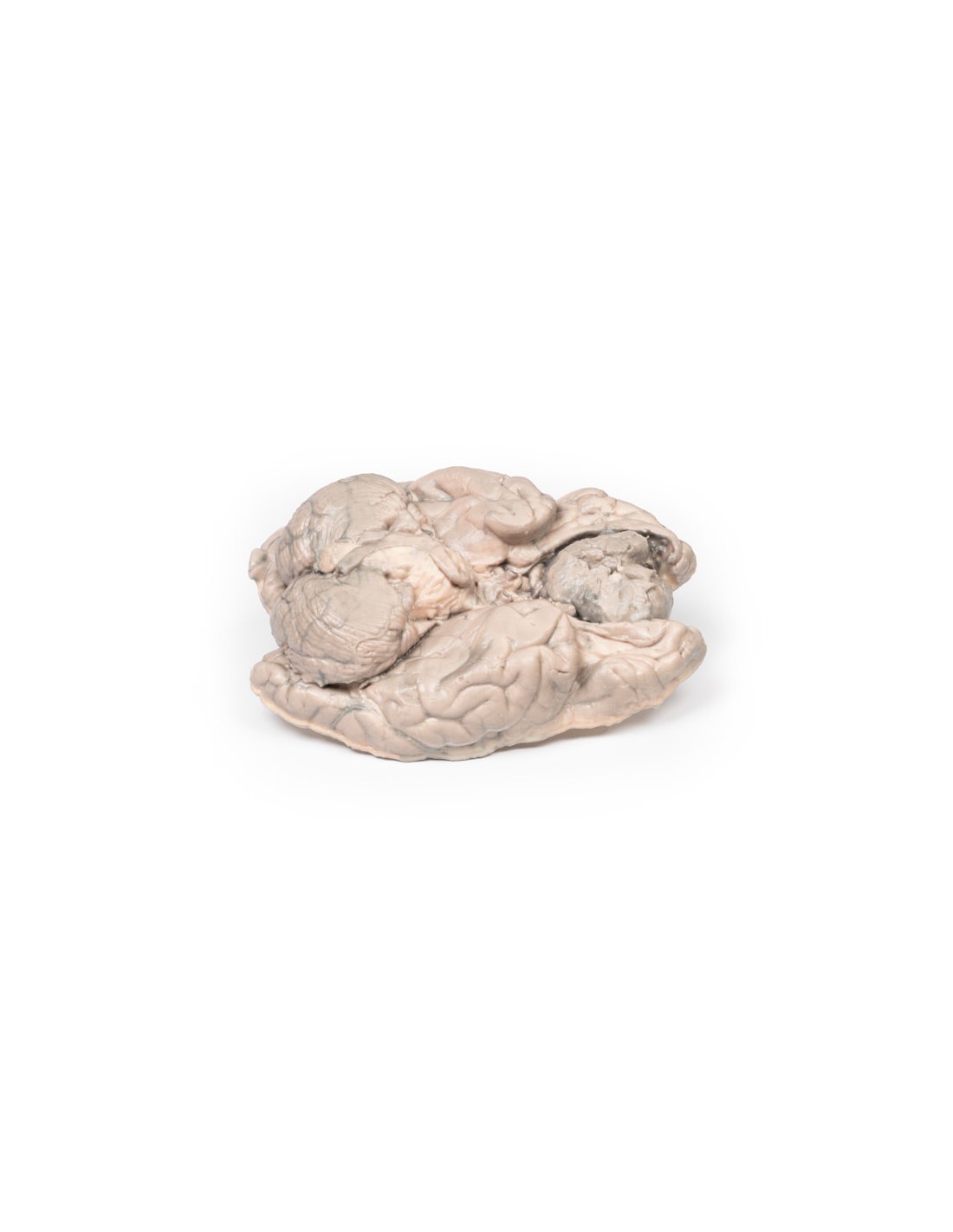 Meningioma - Erler Zimmer 3D anatomy... Meningioma - Erler Zimmer 3D anatomy...