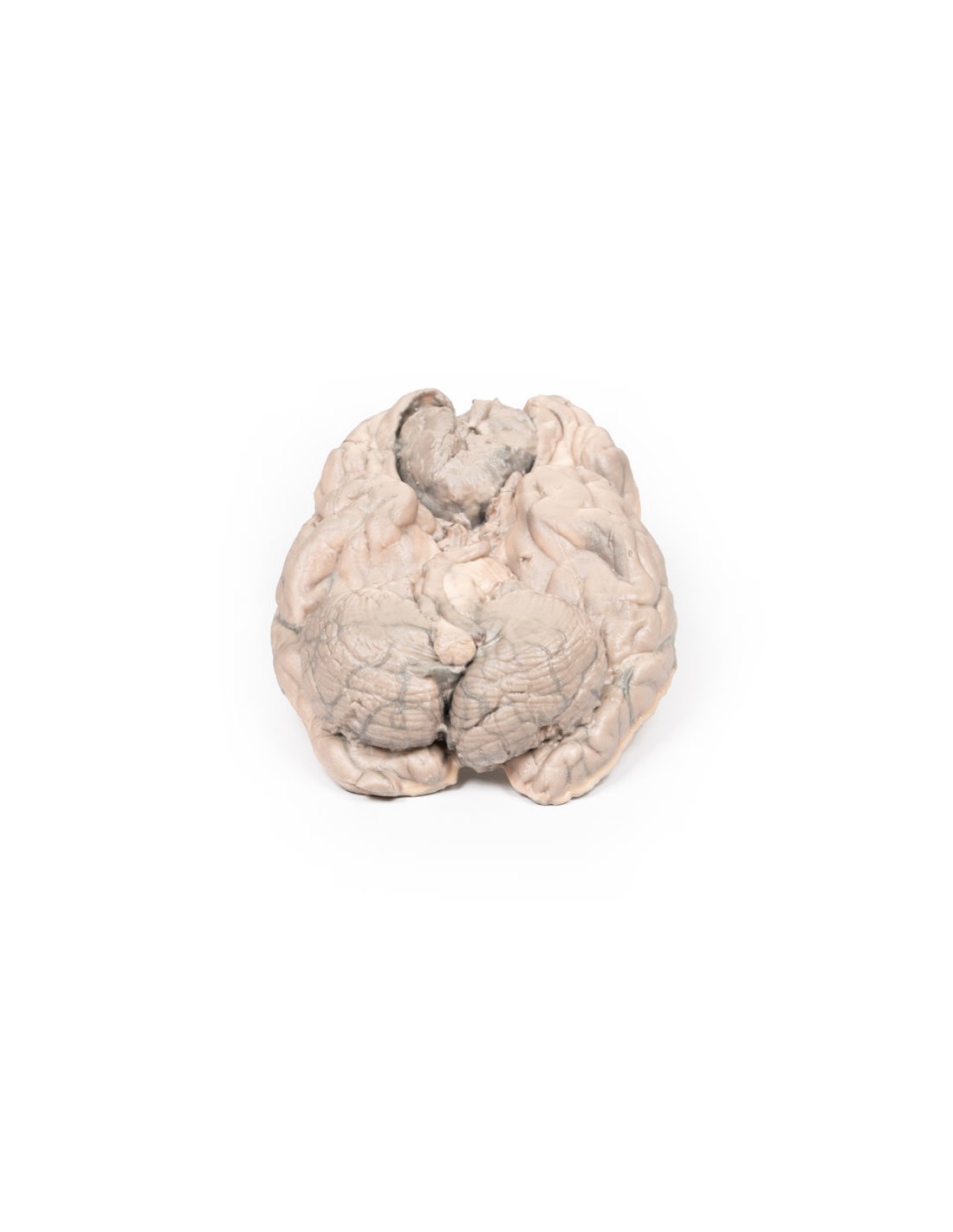 Meningioma - Erler Zimmer 3D anatomy... Meningioma - Erler Zimmer 3D anatomy...
