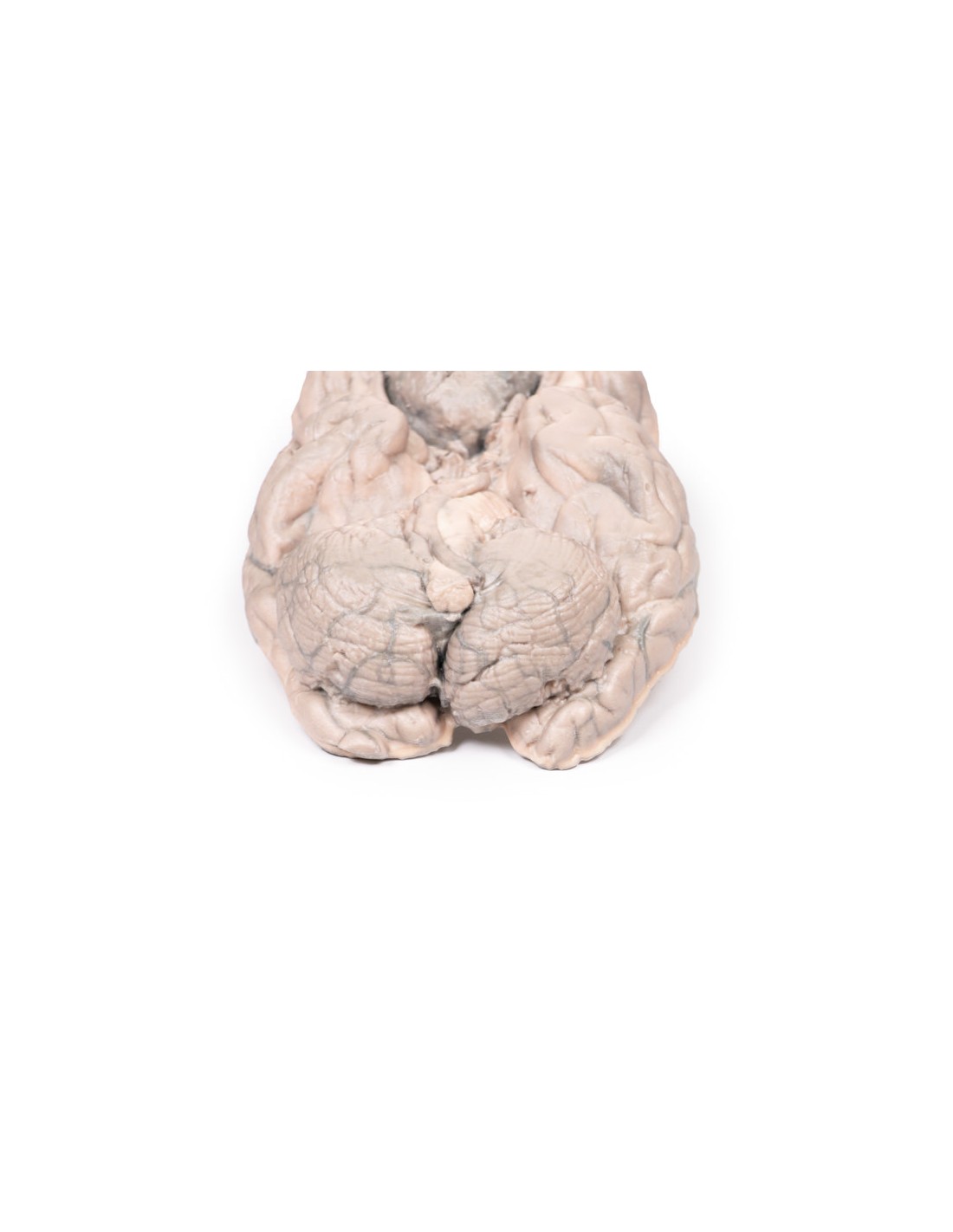 Meningioma - Erler Zimmer 3D anatomy... Meningioma - Erler Zimmer 3D anatomy...