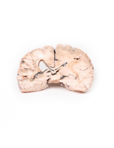Infarto cerebral izquierdo - Erler... Infarto cerebral izquierdo - Erler...