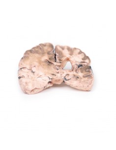 Infarto cerebral izquierdo... 2