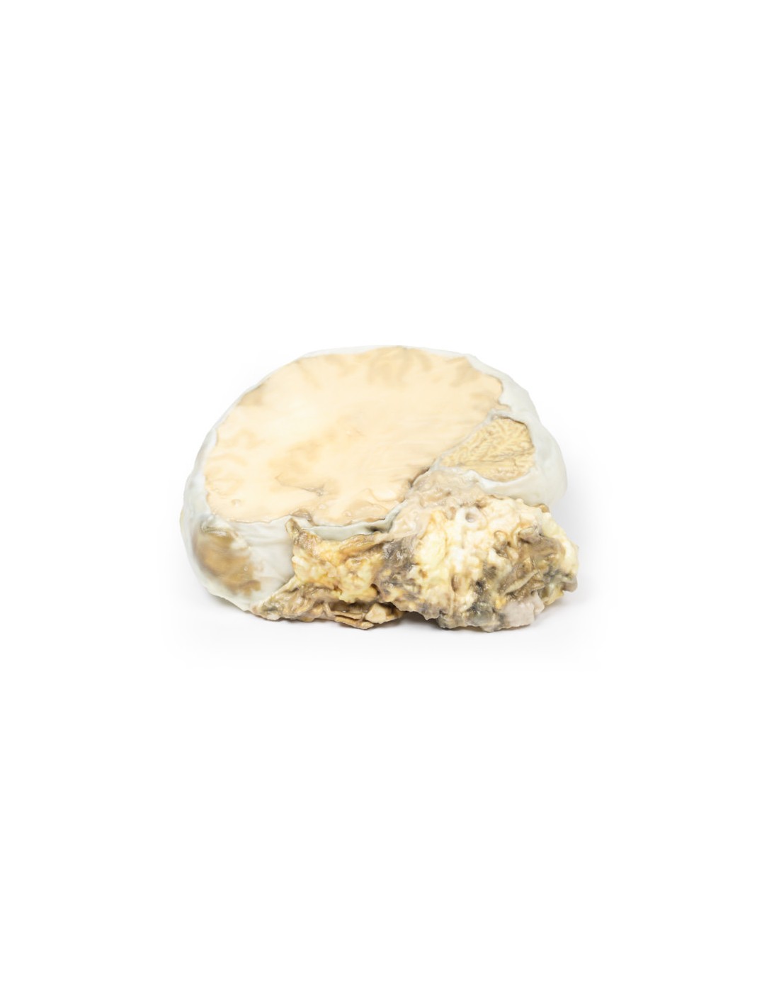 Adenoma pituitario - Erler Zimmer 3D... Adenoma pituitario - Erler Zimmer 3D...