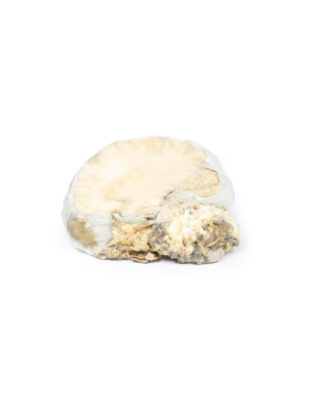 Adenoma pituitario - Erler Zimmer 3D... Adenoma pituitario - Erler Zimmer 3D...