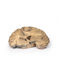 Adenocarcinoma metastásico...
