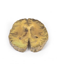 Ventriculitis secundaria a... 2
