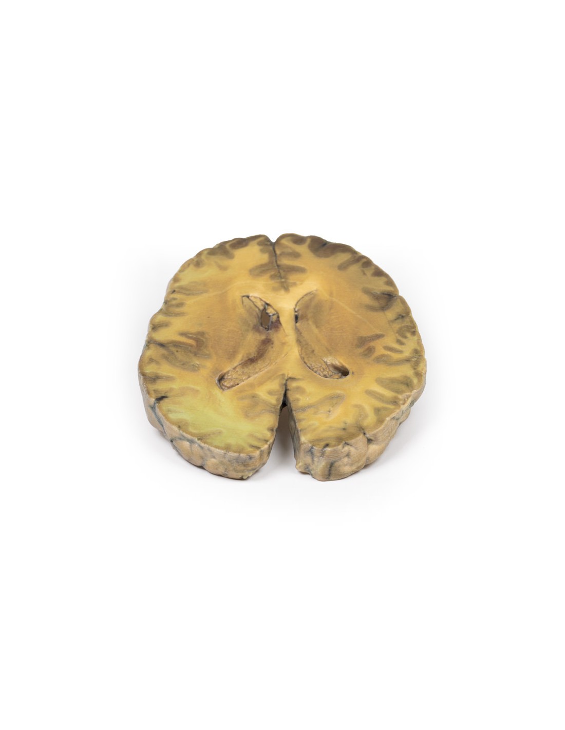 Ventriculitis secundaria a septicemia... Ventriculitis secundaria a septicemia...