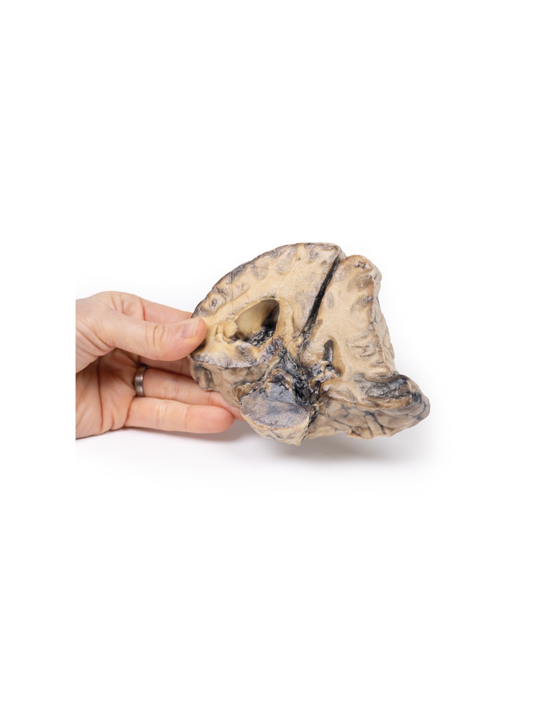 Lesión intracraneal - Erler Zimmer 3D... Lesión intracraneal - Erler Zimmer 3D...