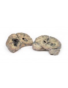 Hemorragia intracerebral -... 2