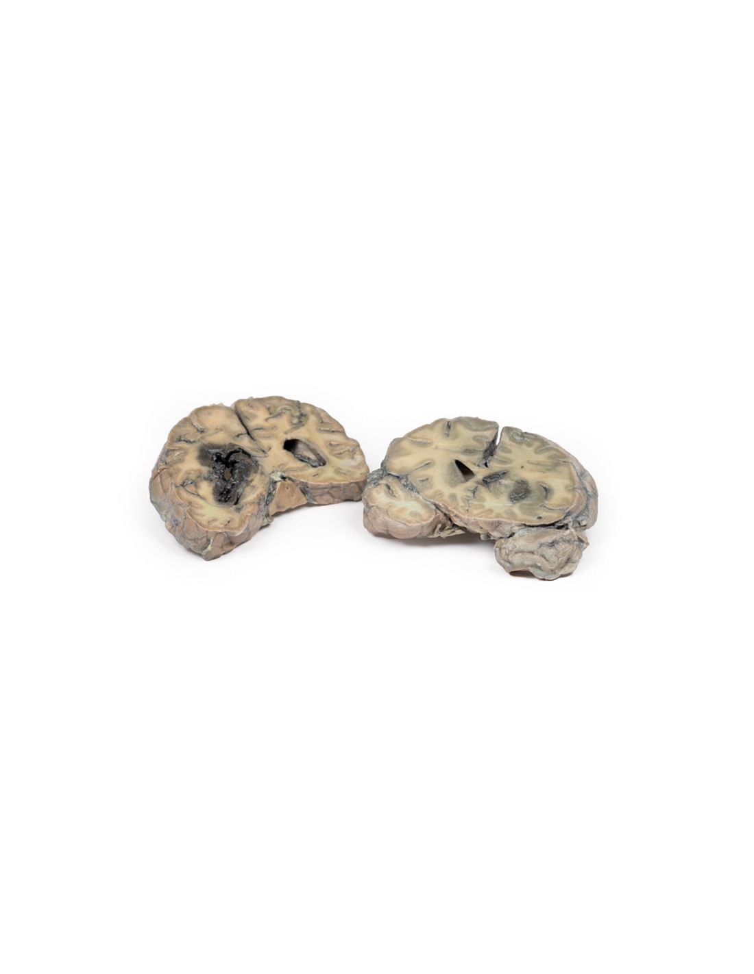Hemorragia intracerebral - Erler... Hemorragia intracerebral - Erler...