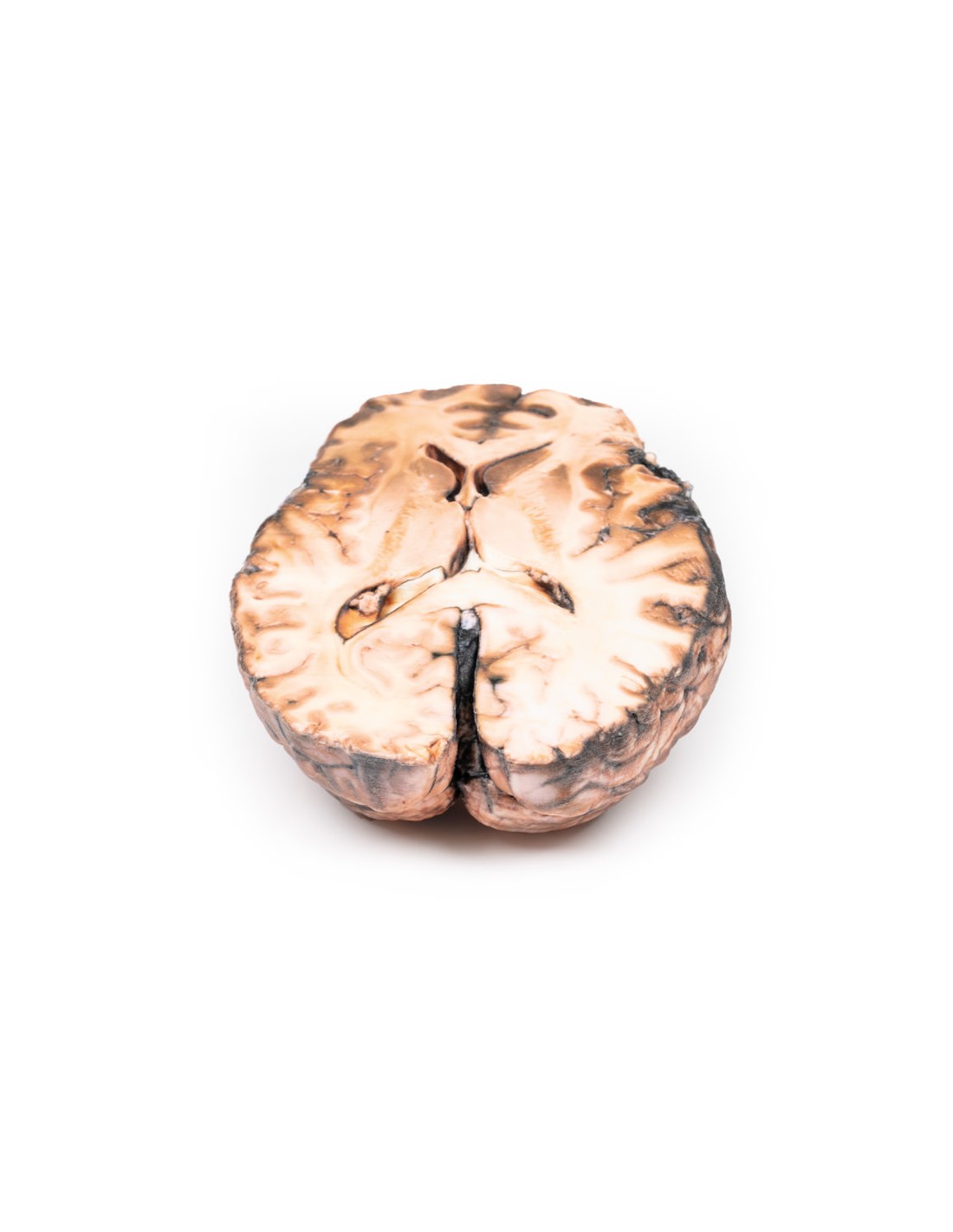 Aneurisma sacular - Erler Zimmer 3D... Aneurisma sacular - Erler Zimmer 3D...
