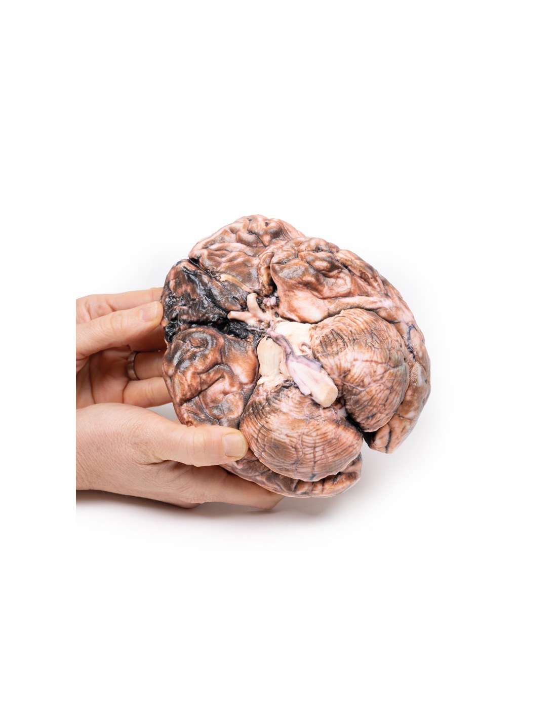 Aneurisma sacular - Erler Zimmer 3D... Aneurisma sacular - Erler Zimmer 3D...