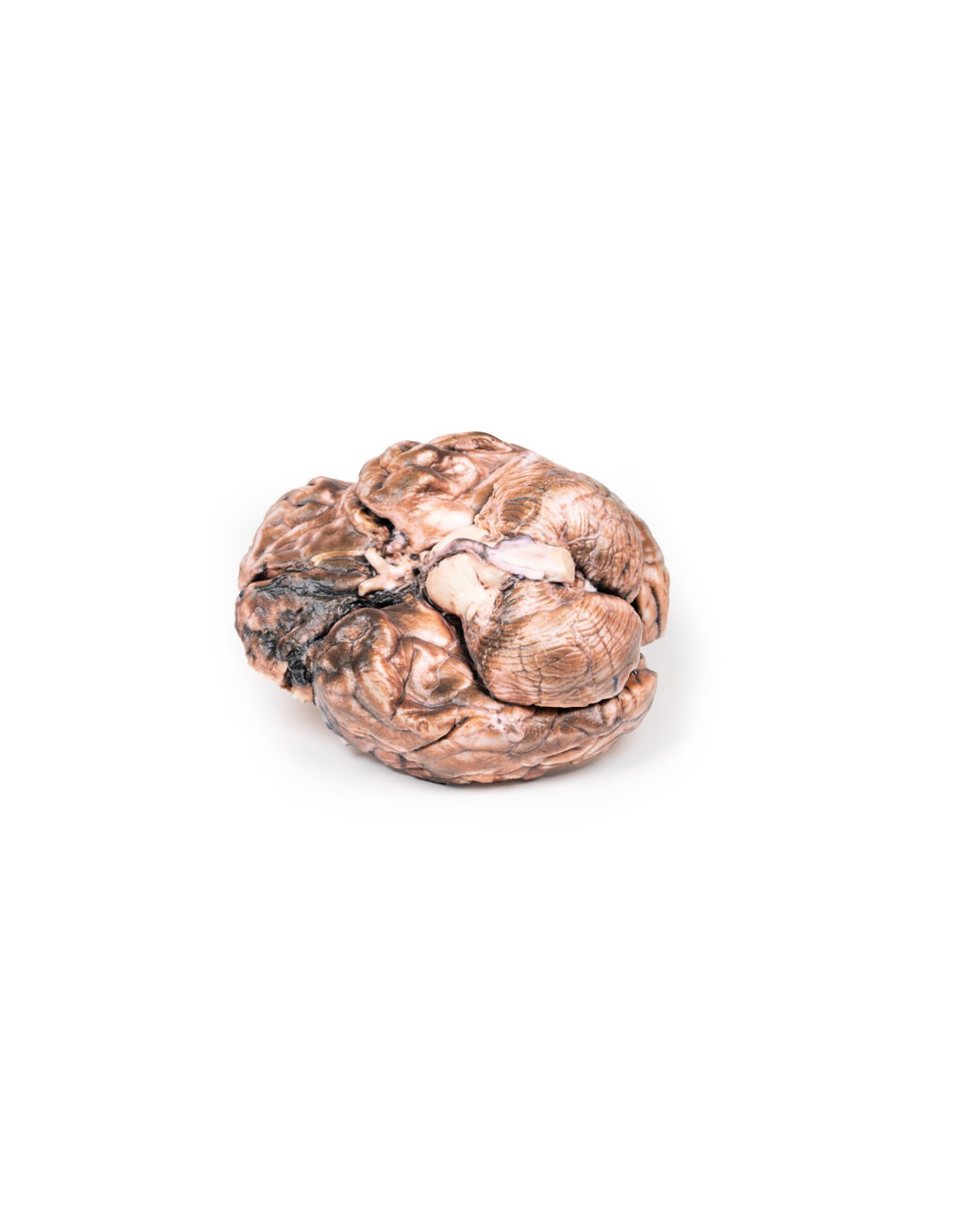 Aneurisma sacular - Erler Zimmer 3D... Aneurisma sacular - Erler Zimmer 3D...