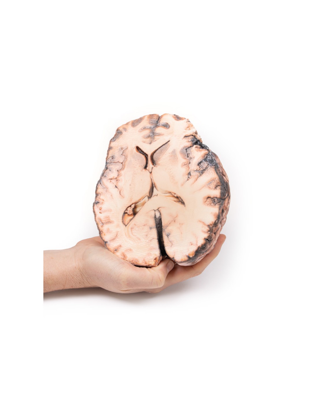 Aneurisma sacular - Erler Zimmer 3D... Aneurisma sacular - Erler Zimmer 3D...
