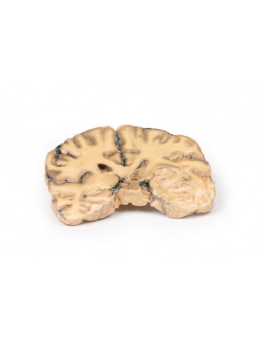 Astrocitoma - Erler Zimmer 3D anatomy... Astrocitoma - Erler Zimmer 3D anatomy...