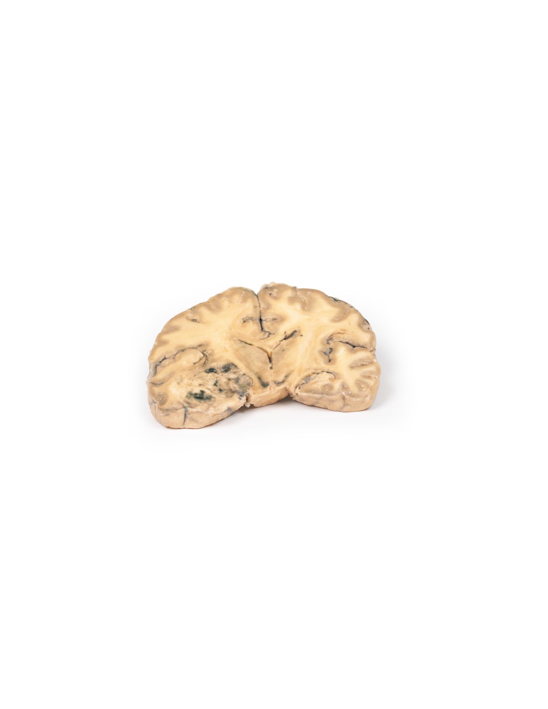 Astrocitoma - Erler Zimmer 3D anatomy... Astrocitoma - Erler Zimmer 3D anatomy...