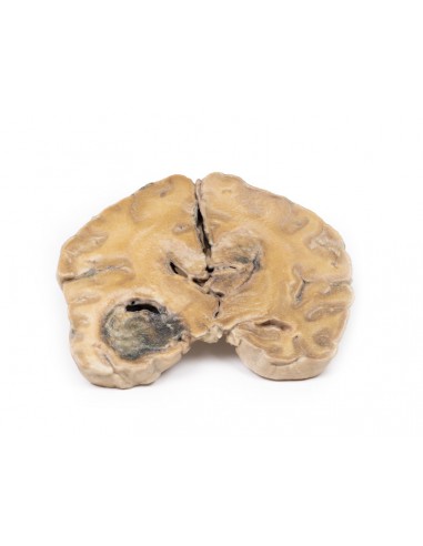 Glioblastoma multiforme - Erler... Glioblastoma multiforme - Erler...