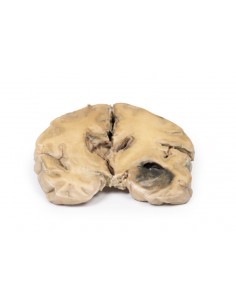 Glioblastoma multiforme -... 2