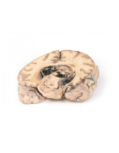 Glioblastoma multiforme - Erler... Glioblastoma multiforme - Erler...
