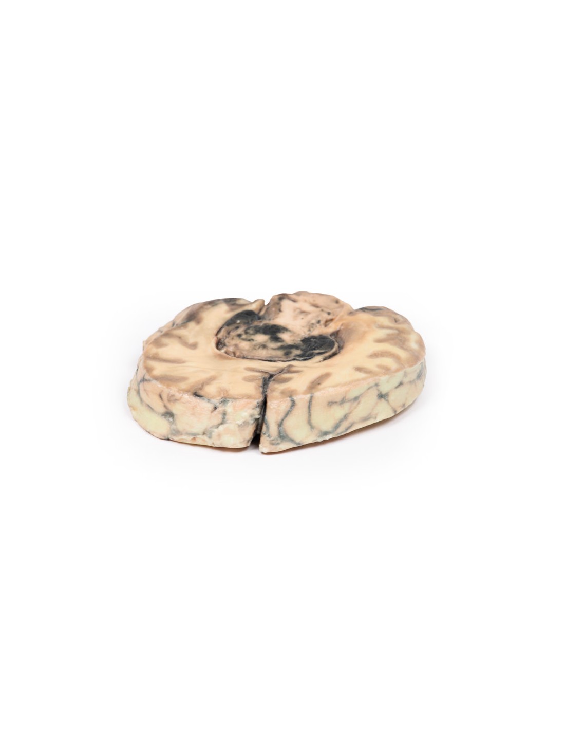 Glioblastoma multiforme - Erler... Glioblastoma multiforme - Erler...