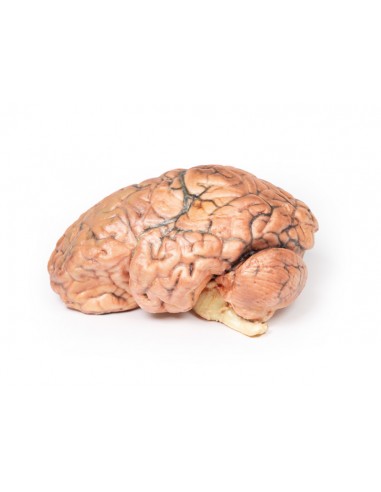 Craneofaringioma - Erler Zimmer 3D... Craneofaringioma - Erler Zimmer 3D...