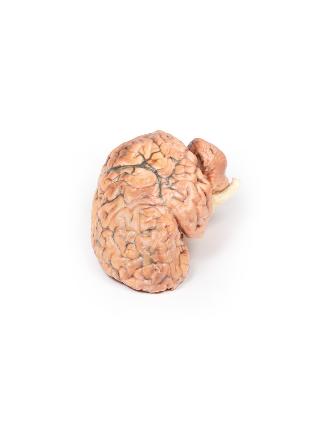 Craneofaringioma - Erler Zimmer 3D... Craneofaringioma - Erler Zimmer 3D...