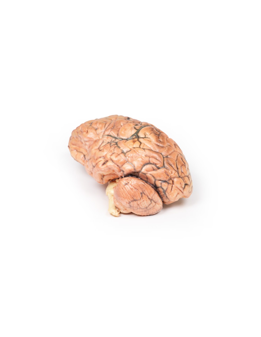 Craneofaringioma - Erler Zimmer 3D... Craneofaringioma - Erler Zimmer 3D...