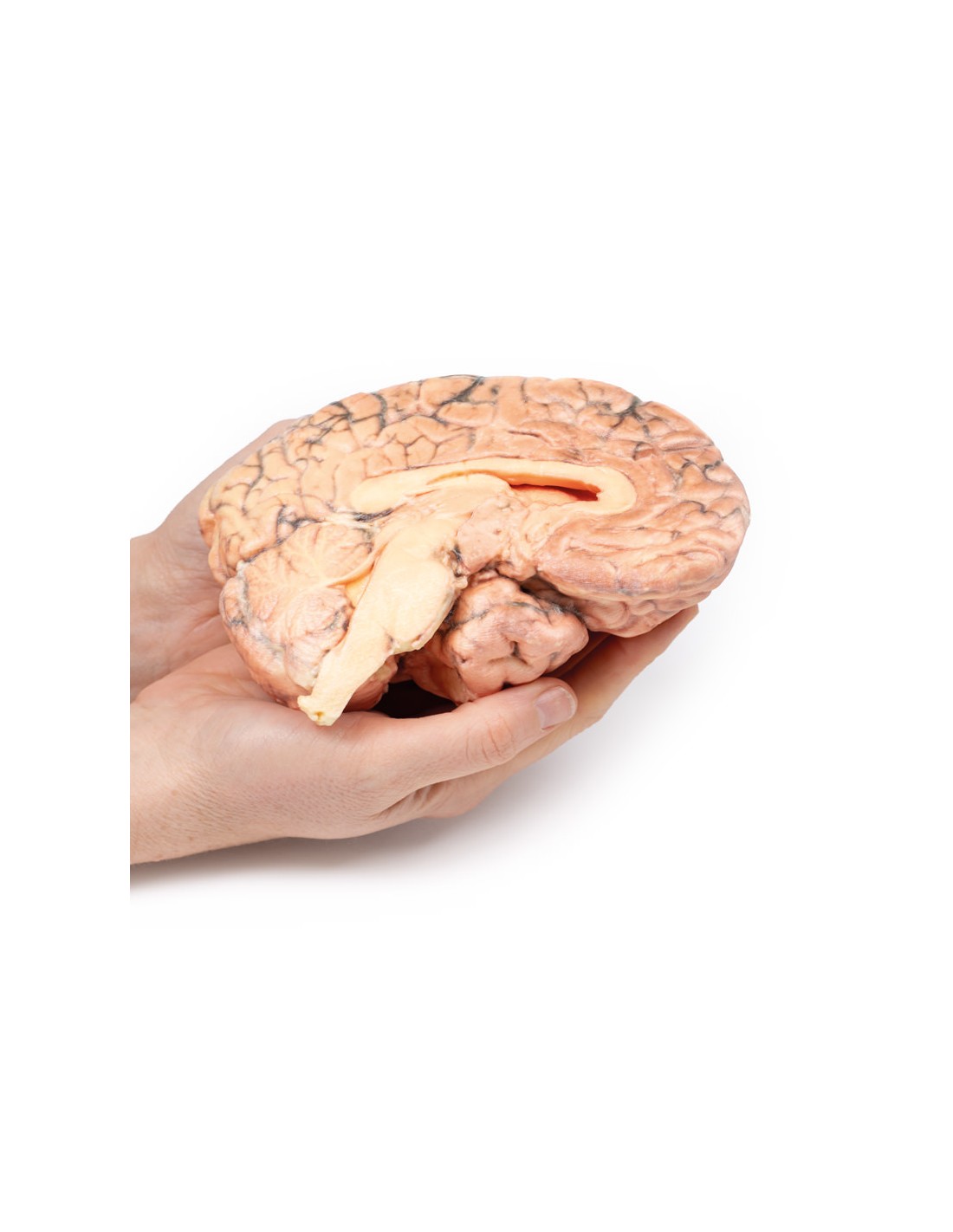Craneofaringioma - Erler Zimmer 3D... Craneofaringioma - Erler Zimmer 3D...