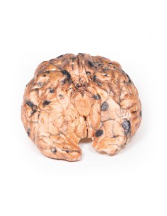 Melanoma metastásico -...