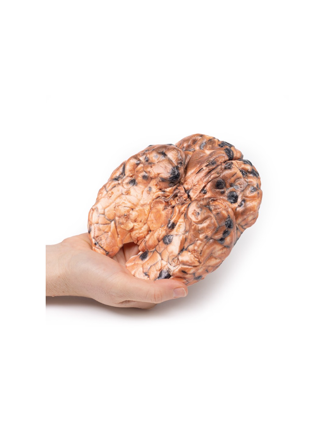 Melanoma metastásico - Erler Zimmer... Melanoma metastásico - Erler Zimmer...