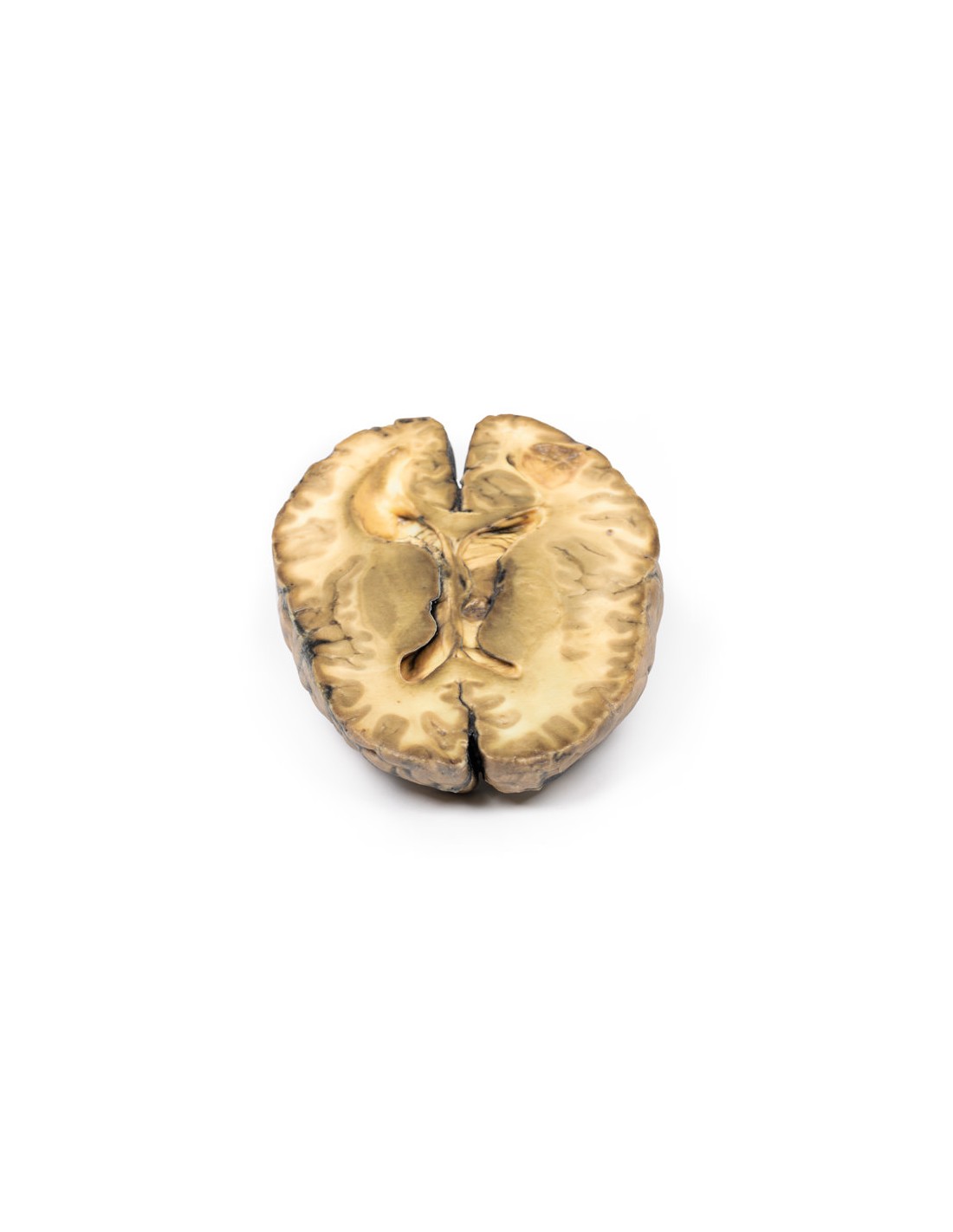 Cáncer metastásico en el cerebro -... Cáncer metastásico en el cerebro -...