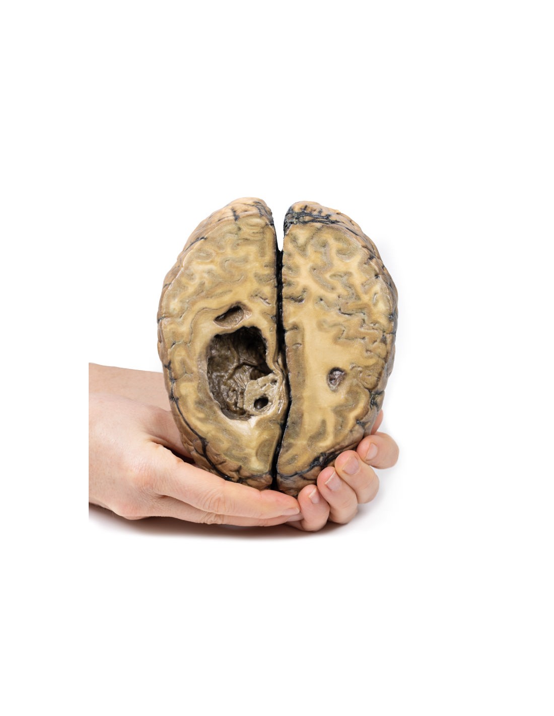 Cáncer metastásico en el cerebro -... Cáncer metastásico en el cerebro -...