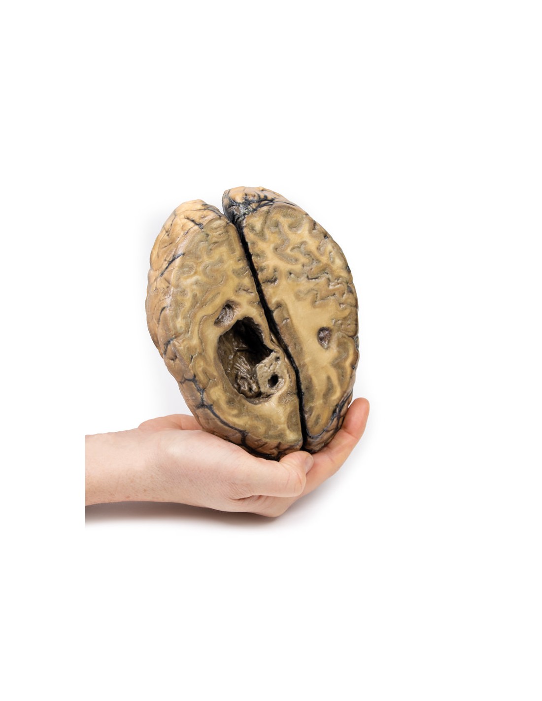 Cáncer metastásico en el cerebro -... Cáncer metastásico en el cerebro -...