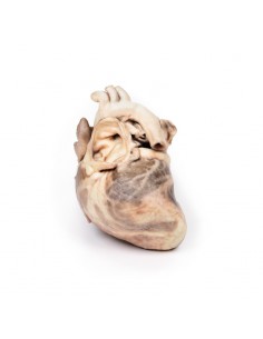 Estenosis pulmonar...
