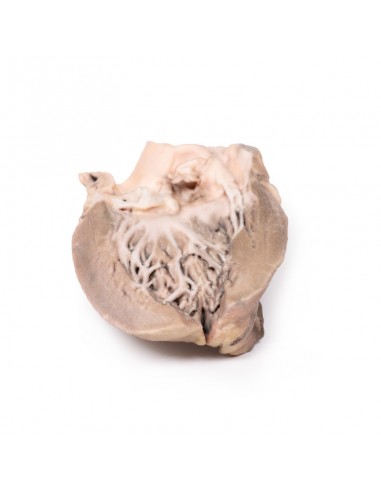 Endocarditis bacteriana aguda - Erler... Endocarditis bacteriana aguda - Erler...