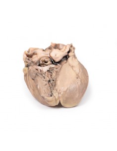 Endocarditis bacteriana... 2