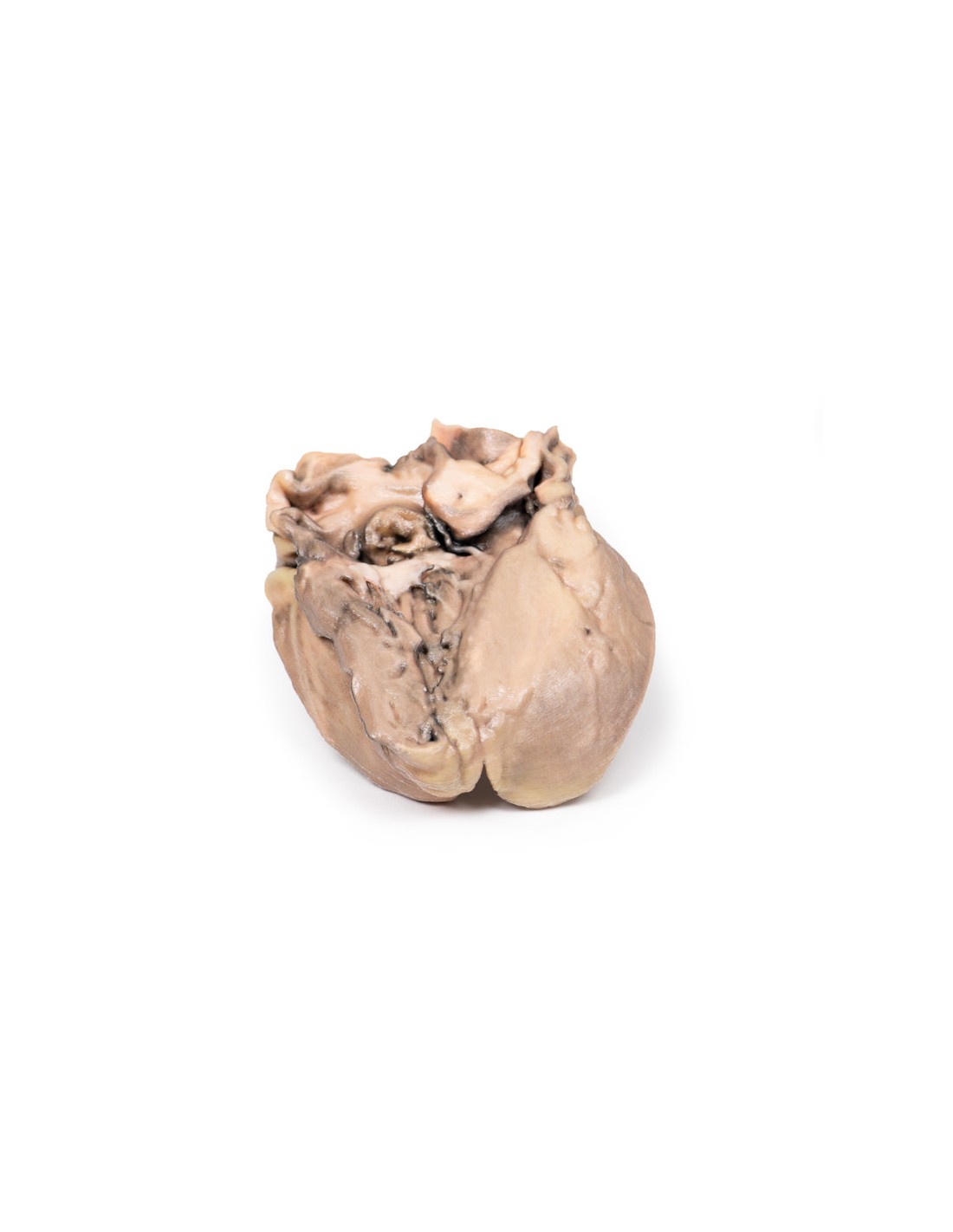 Endocarditis bacteriana aguda - Erler... Endocarditis bacteriana aguda - Erler...