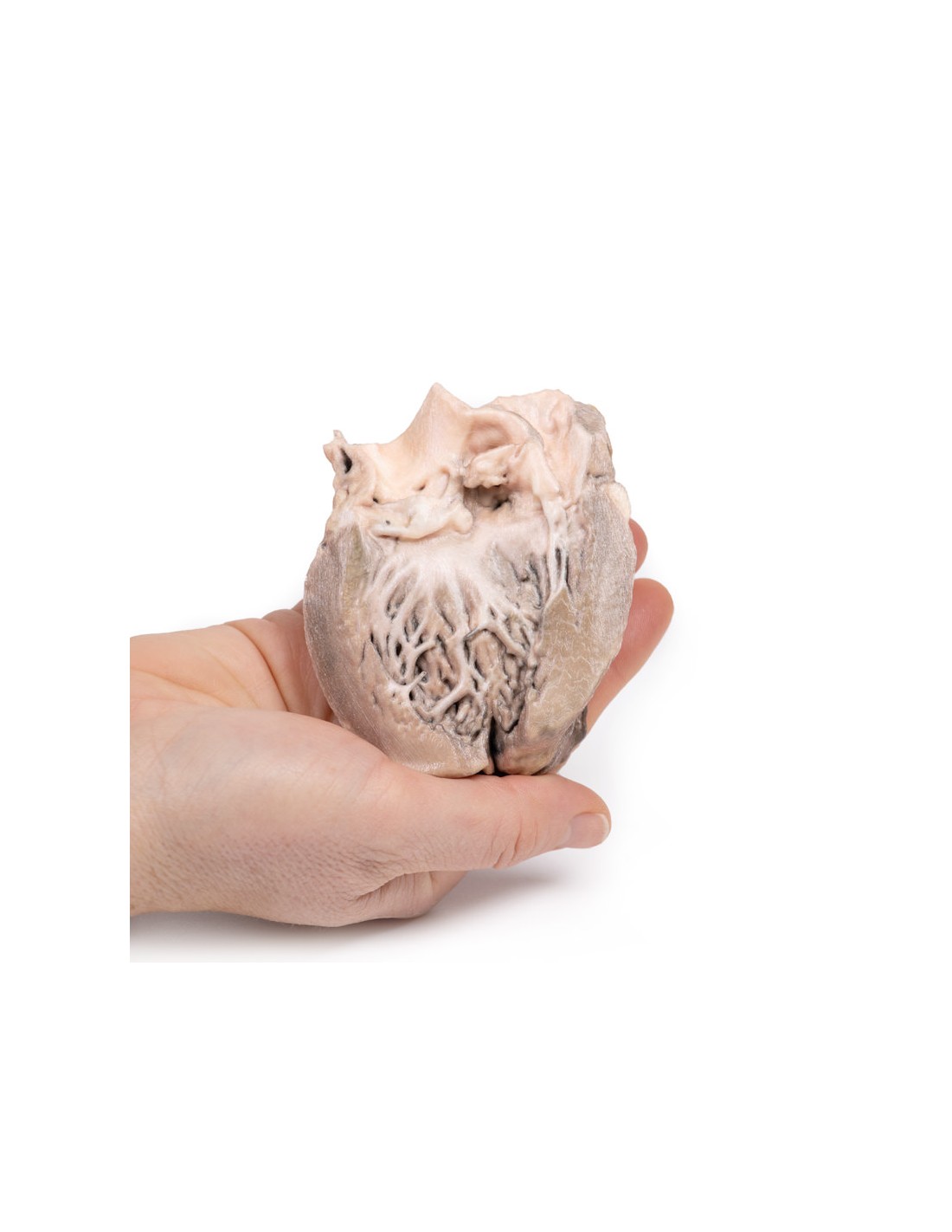 Endocarditis bacteriana aguda - Erler... Endocarditis bacteriana aguda - Erler...