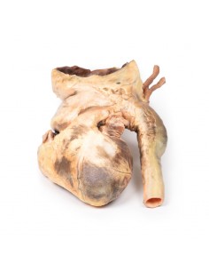 Aneurisma sifilítico -...