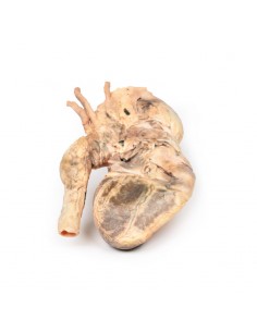 Aneurisma sifilítico -... 2