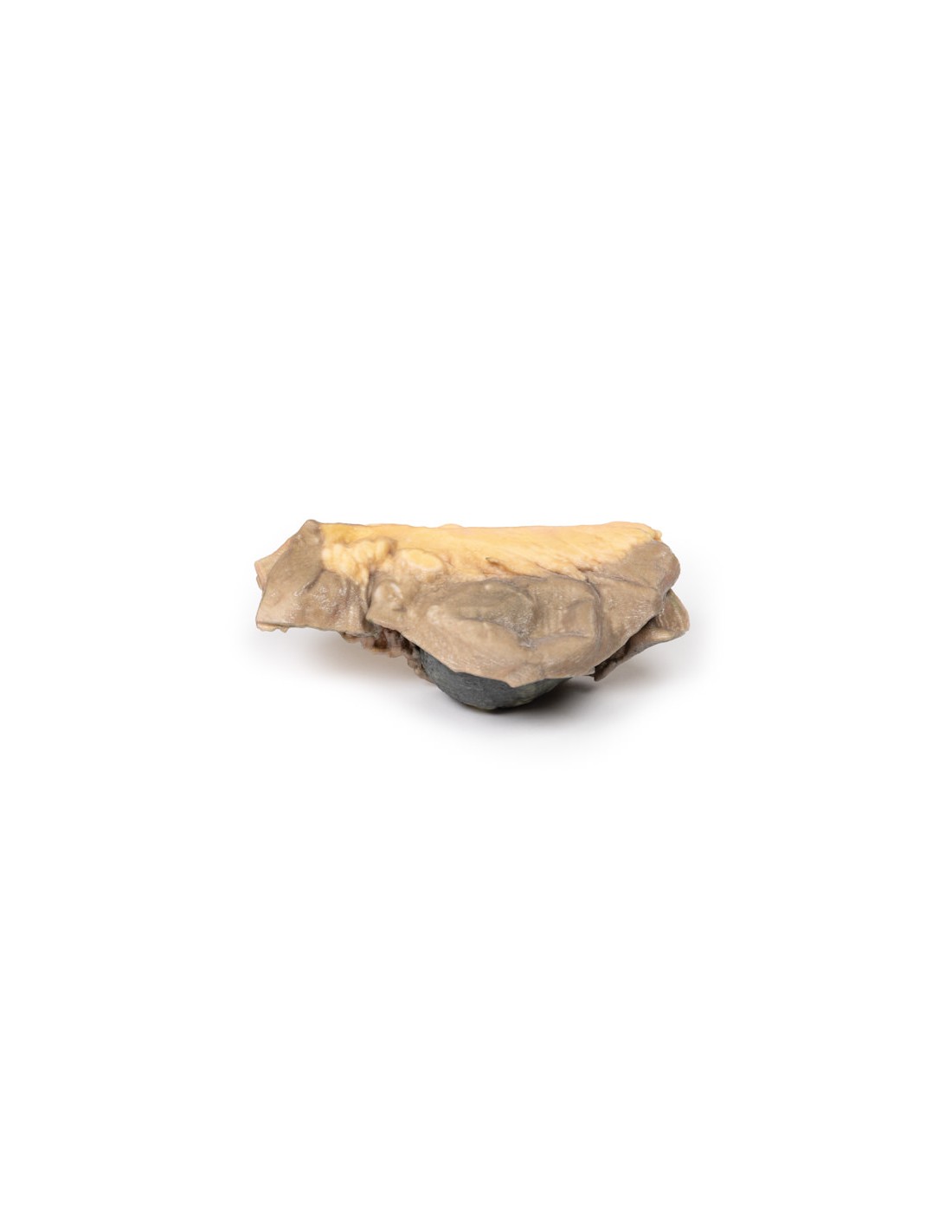 Íleo con piedras - Erler Zimmer 3D... Íleo con piedras - Erler Zimmer 3D...